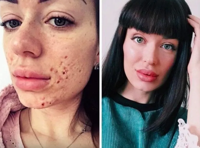 Zdjęcie Skuteczne sposoby na pryszcze na twarzy – uniknij trądziku już dziś