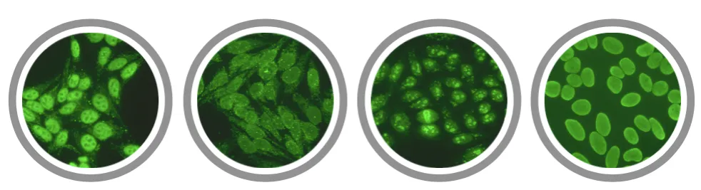 Zdjęcie Co wykrywa badanie ANA 2? Kluczowe informacje o przeciwciałach i chorobach autoimmunologicznych