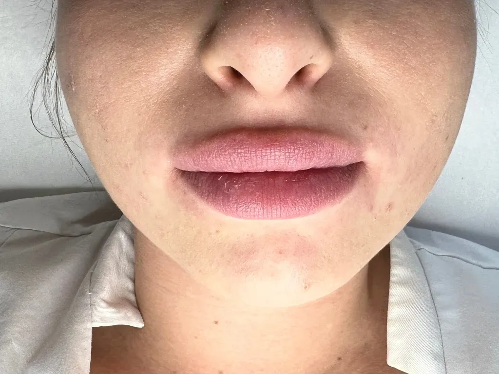 Zdjęcie Czy powiększanie ust kwasem hialuronowym jest bezpieczne? Poznaj ryzyko