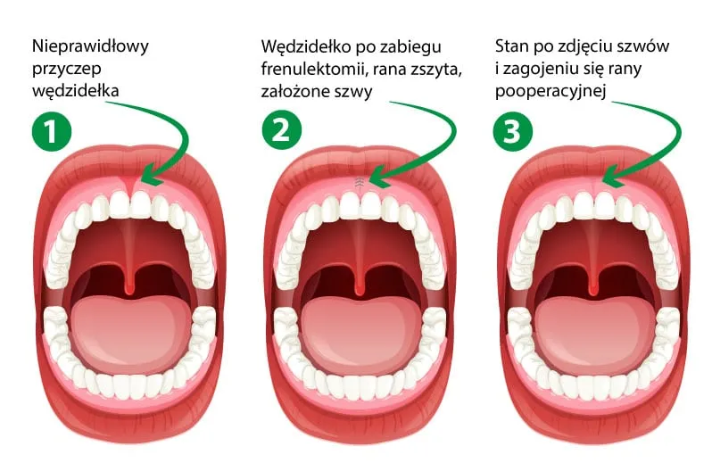 Zdjęcie Ćwiczenia po podcięciu wędzidełka: Kiedy zacząć i jak ćwiczyć?