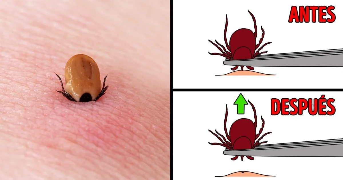 Zdjęcie Consecuencias de una garrapata mal quitada en persona y cómo actuar