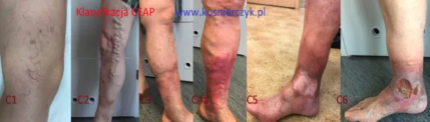 Zdjęcie Niewydolność zastawek żylnych - poznaj skuteczne metody leczenia w 2025