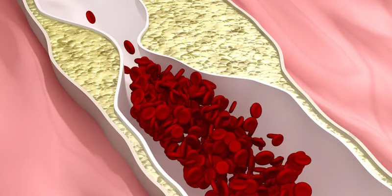 Zdjęcie Czy cholesterol jest dziedziczny? Poznaj ryzyko i skutki zdrowotne