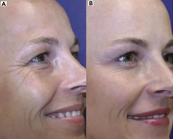 Zdjęcie Botoks pod oczy: Kiedy efekty? Pełny rezultat po 10-14 dniach