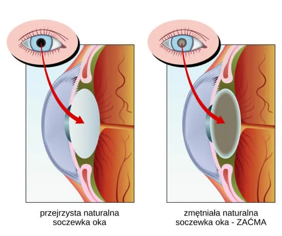 Zdjęcie Jak zatrzymać zaćmę? Skuteczne metody na opóźnienie jej rozwoju