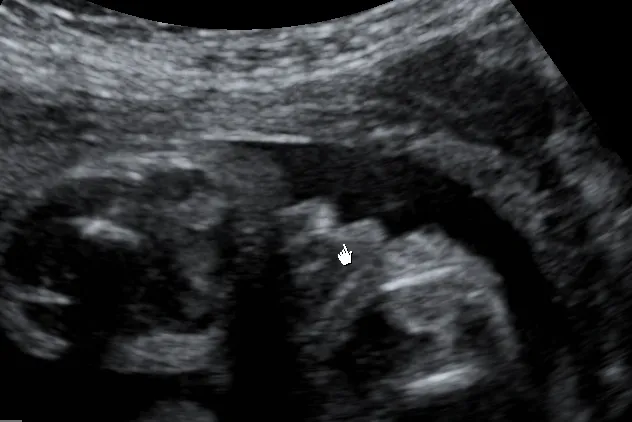 Zdjęcie Jak rozpoznać płeć dziecka na usg - co musisz wiedzieć, by nie pomylić