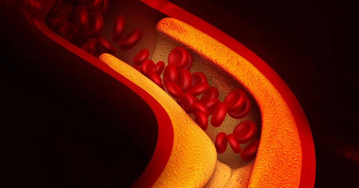 Zdjęcie Czy cholesterol rośnie od stresu? Sprawdź, jak stres wpływa na zdrowie