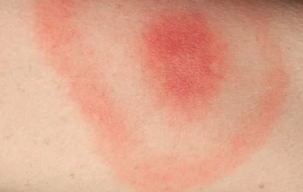 Zdjęcie Jak wygląda ugryzienie węża? Objawy, które mogą cię zaskoczyć