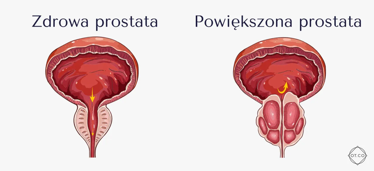 Zdjęcie Jak rozpoznać przód pampersa i uniknąć problemów z zakładaniem