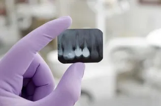 Zdjęcie Ile naprawdę kosztuje plomba u dentysty i jak uniknąć wysokich rachunków