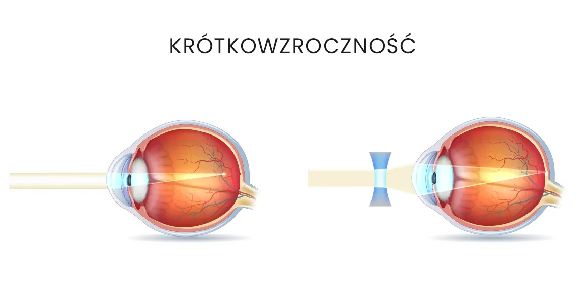 Zdjęcie Czy krótkowzroczność można wyleczyć? Prawda o skutecznych metodach