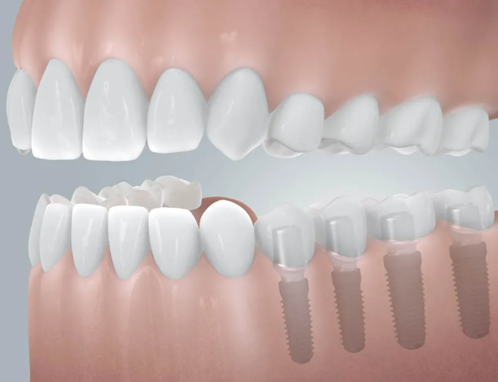 Zdjęcie Czy po wszczepieniu implantu zęba można iść do pracy bez obaw?