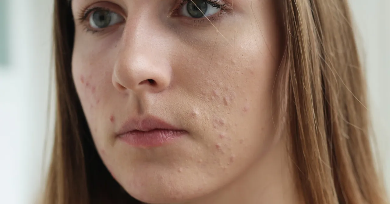 Zdjęcie Czy Sudocrem pomaga na pryszcze? Odkryj prawdę o jego skuteczności