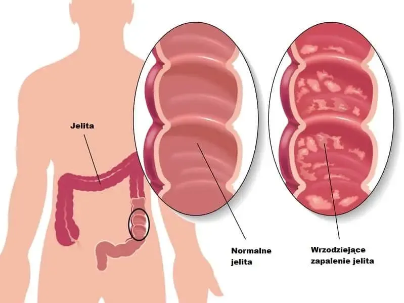 Zdjęcie Zapalenie jelita grubego objawy – poznaj niepokojące sygnały zdrowia