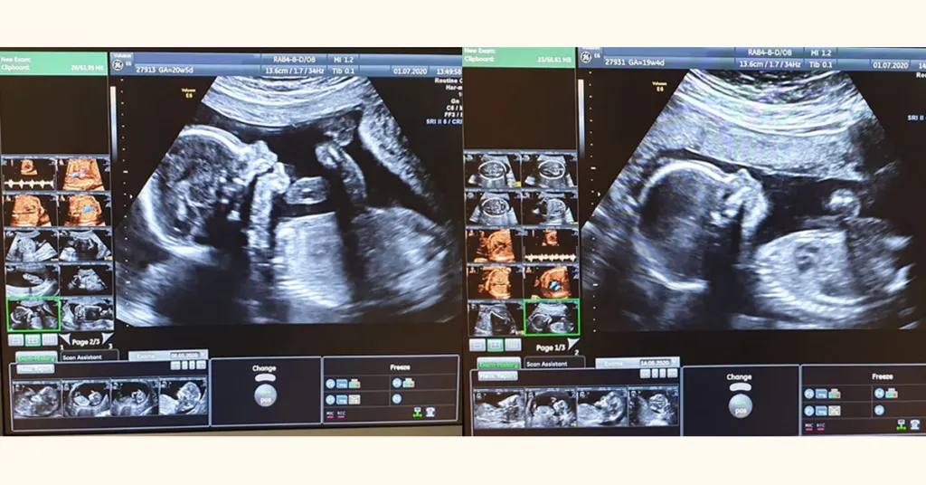 Zdjęcie 3 badania prenatalne kiedy należy wykonać, aby zapewnić zdrowie dziecka