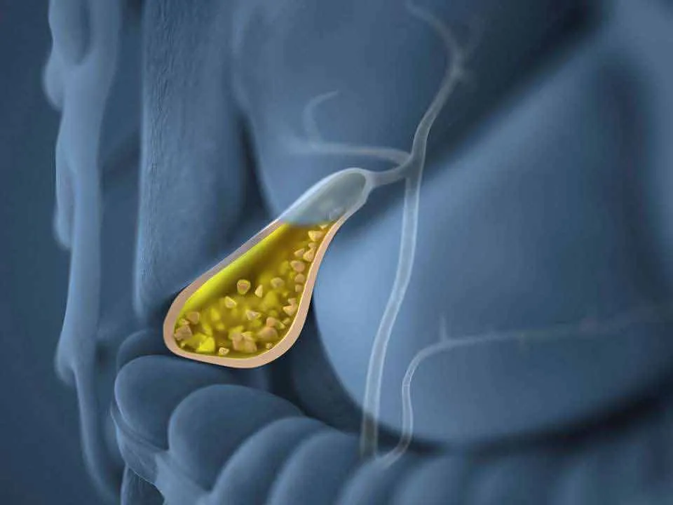 Zdjęcie Kolka żółciowa objawy: Jak rozpoznać ból i uniknąć powikłań