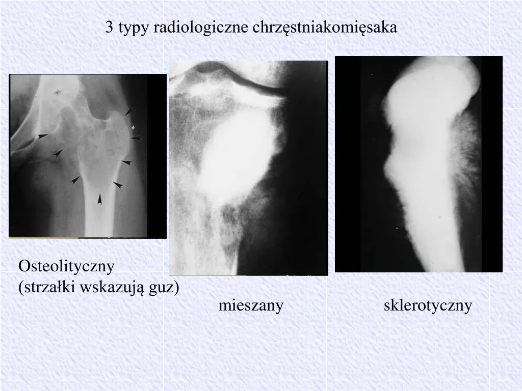 Zdjęcie Nowotwór kości miednicy objawy - jak rozpoznać niebezpieczne sygnały