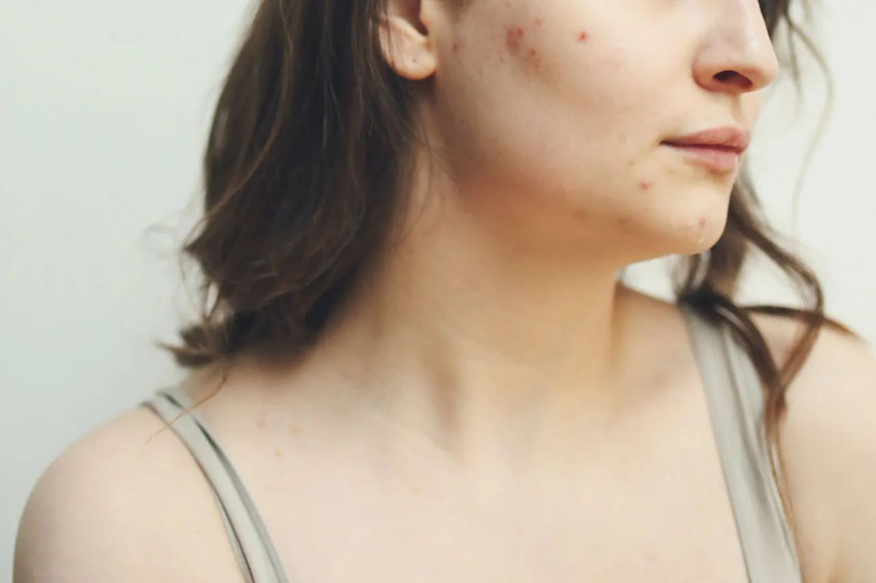 Zdjęcie Czy bez uczula? Poznaj objawy alergii i jak ich uniknąć