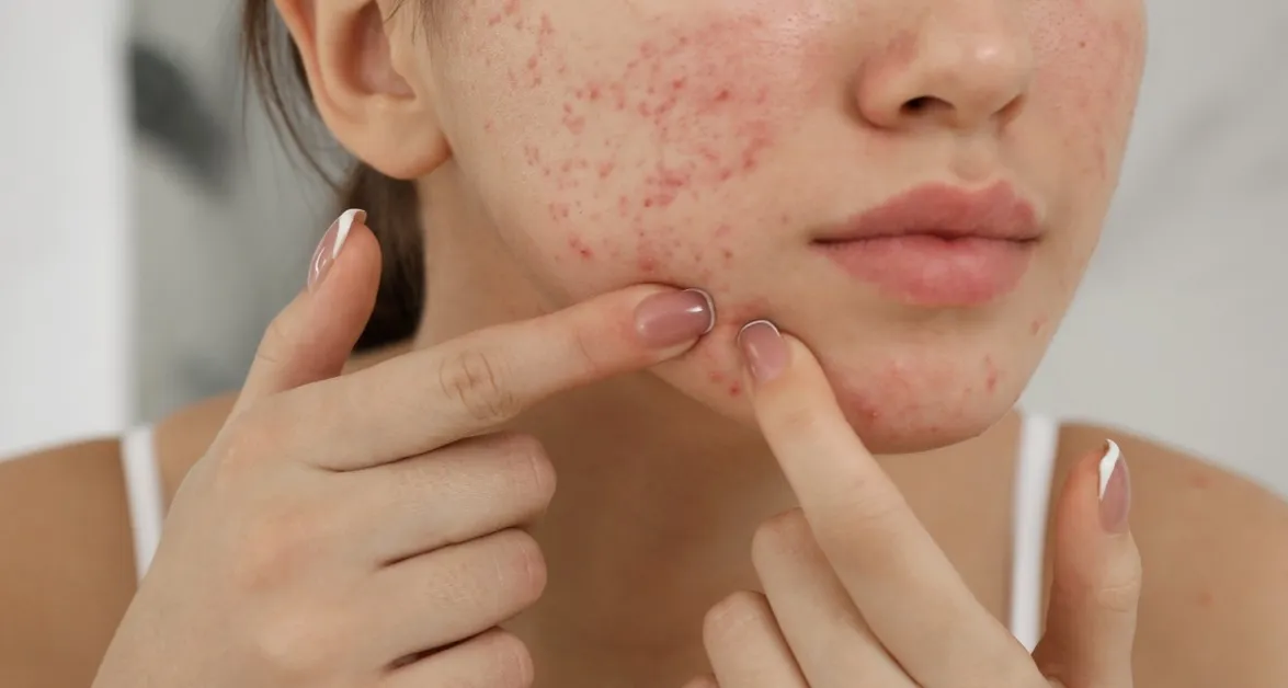Zdjęcie Jak przestać wyciskać pryszcze i poprawić zdrowie skóry