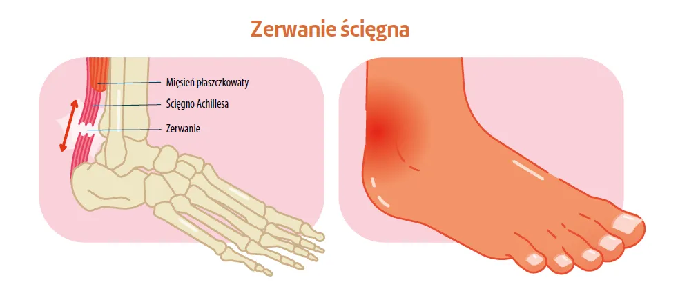 Zdjęcie Jakie leki na zerwane ścięgna? Skuteczne metody łagodzenia bólu