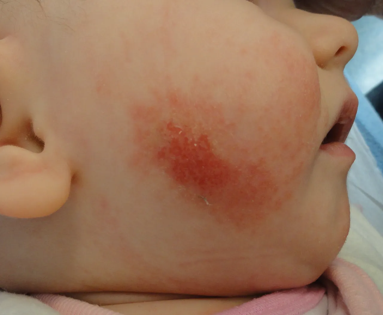 Zdjęcie Skuteczne sposoby na azs u niemowlaka – jak złagodzić objawy?