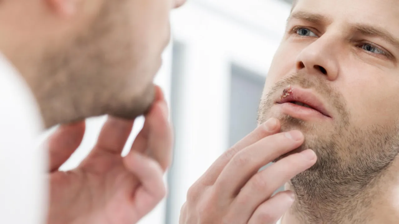 Zdjęcie Czy można iść do dentysty z opryszczką? Sprawdź, co musisz wiedzieć