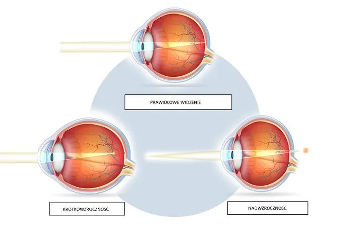 Zdjęcie Czy wada wzroku może się zmniejszyć? Odkryj prawdę o poprawie widzenia