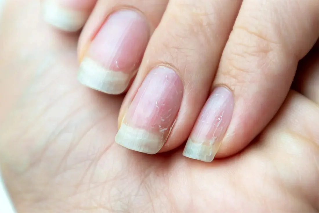 Zdjęcie Cómo endurecer las uñas débiles con remedios naturales efectivos