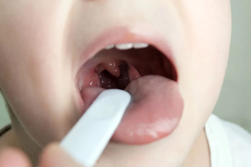 Zdjęcie Jak leczyć zapalenie gardła u dziecka? Skuteczne metody i porady