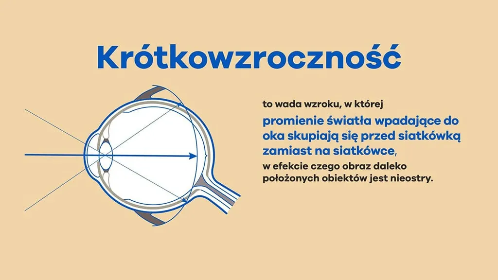 Zdjęcie Krótkowzroczność: Jak poprawić wzrok? Kompleksowy przewodnik