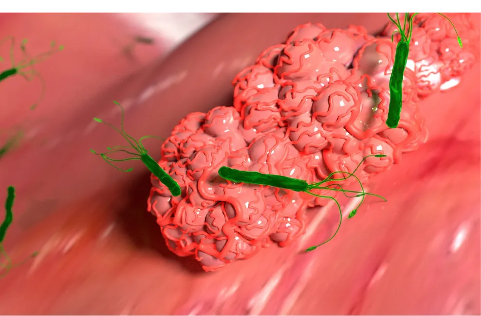 Zdjęcie Síntomas de Helicobacter: ¿Estás Ignorando Señales de Alarma?