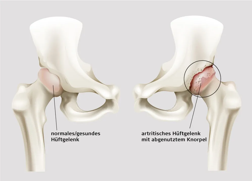 Zdjęcie Coxarthrose Symptome: So erkennen Sie die schmerzhaften Anzeichen