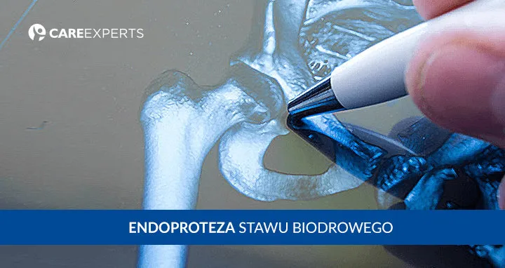 Zdjęcie Obluzowanie endoprotezy stawu biodrowego – objawy, które mogą niepokoić