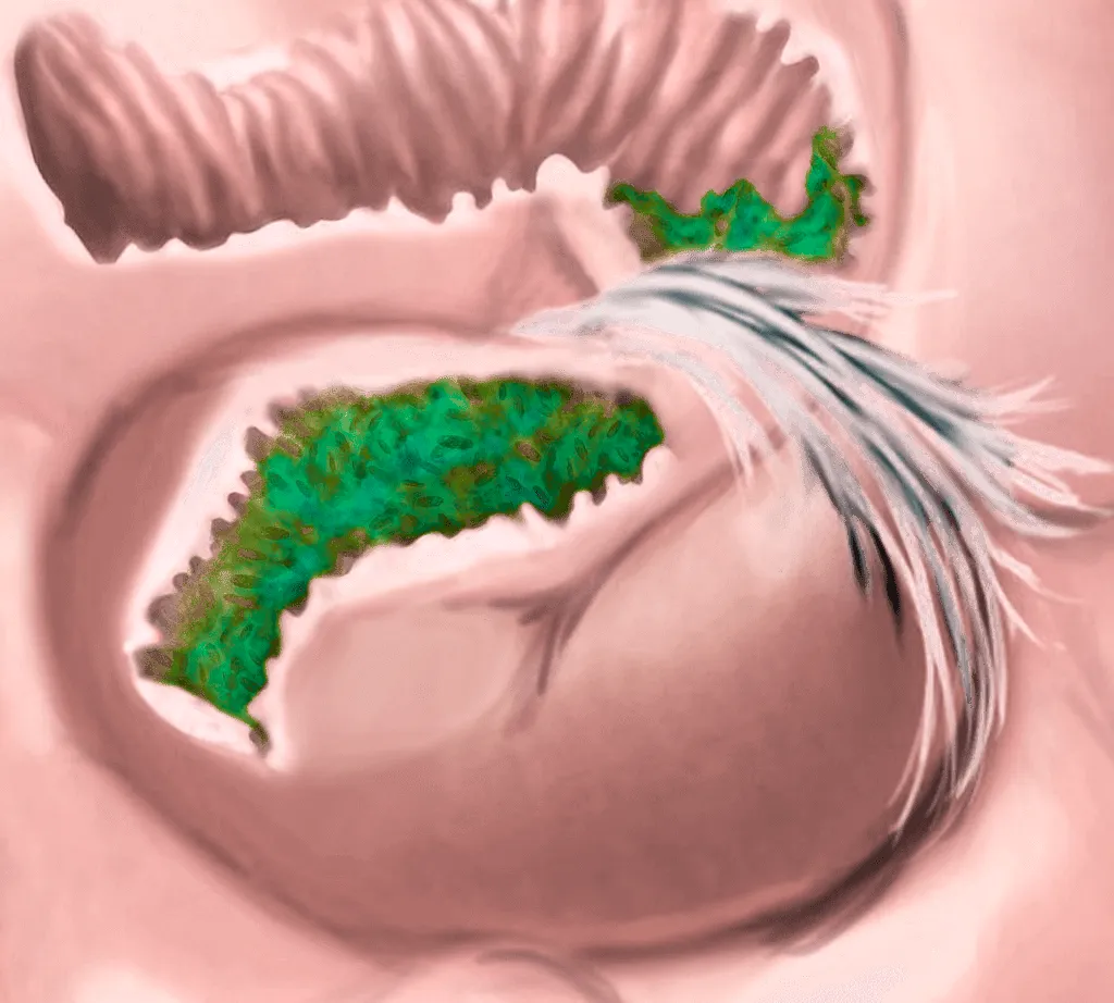 Zdjęcie Zrosty pooperacyjne objawy: Jak rozpoznać i uniknąć bólu?