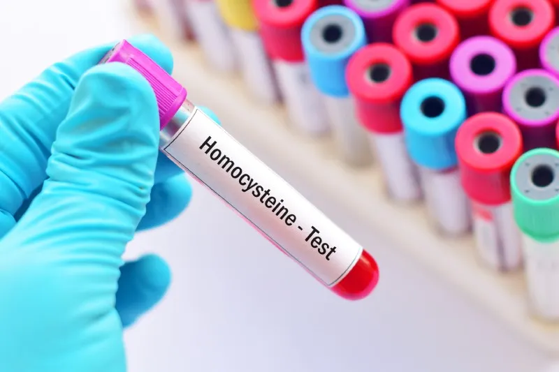 Zdjęcie Homocysteina – co to za badanie i dlaczego warto je wykonać?