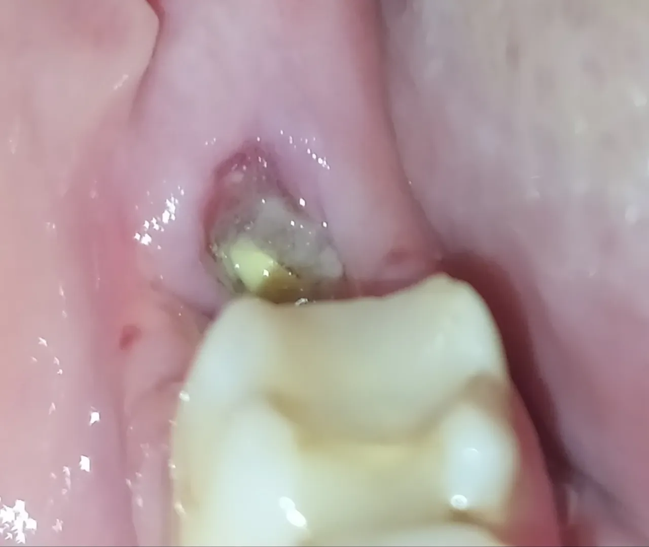 Zdjęcie Jak długo boli dziąsło po usunięciu zęba? Sprawdź, co musisz wiedzieć