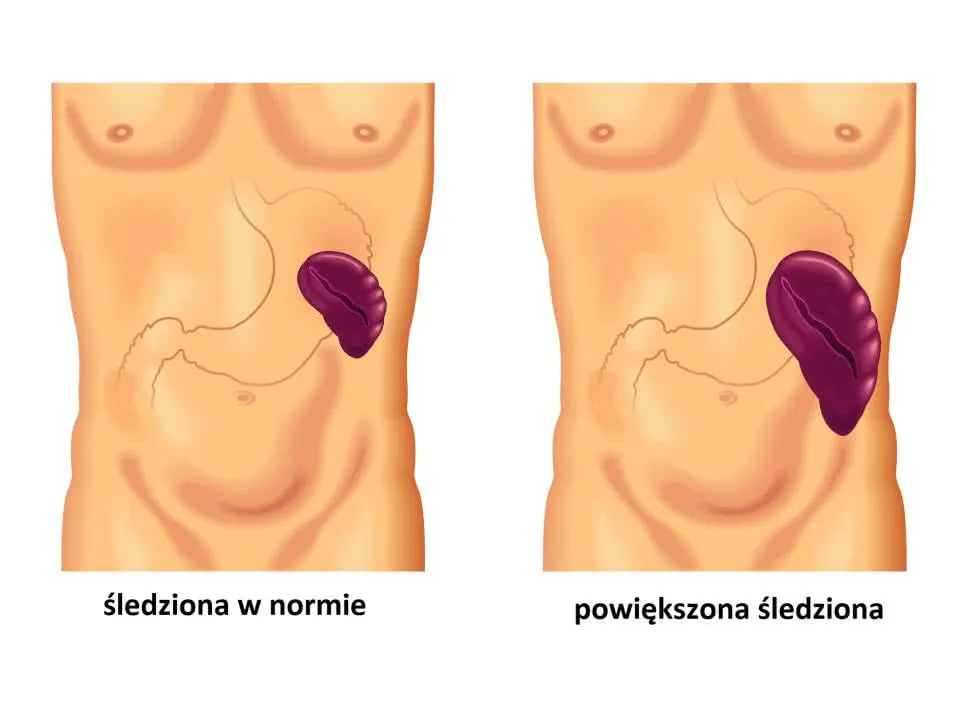 Zdjęcie Jak złagodzić ból śledziony i uniknąć poważnych problemów zdrowotnych