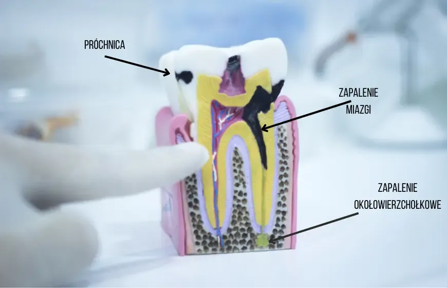 Zdjęcie Ból zęba? Jak szybko poczuć ulgę i kiedy pilnie do dentysty.