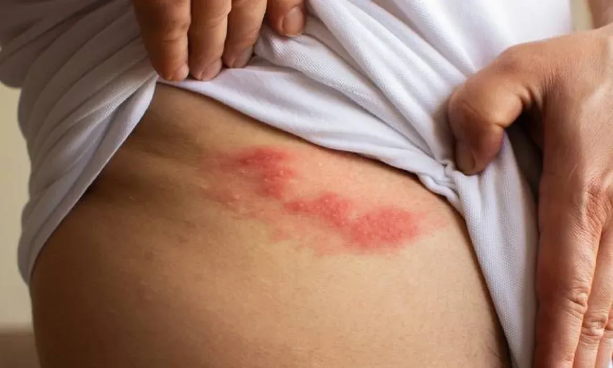 Zdjęcie Czy odleżyny prowadzą do śmierci? Poznaj ryzyko powikłań i zapobieganie