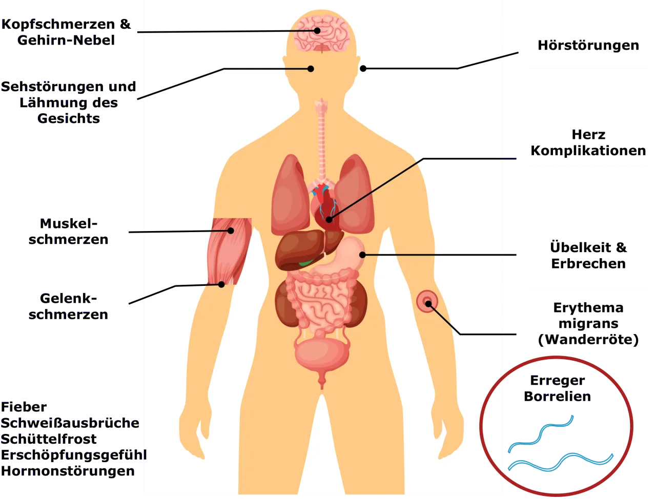 Zdjęcie Neuroborreliose Symptome: Warnsignale, die Sie nicht ignorieren sollten