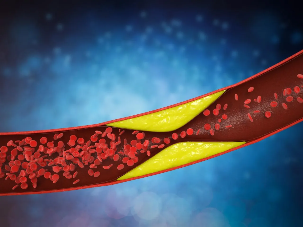 Zdjęcie Podwyższony poziom trójglicerydów objawy: niebagatelne sygnały zdrowotne