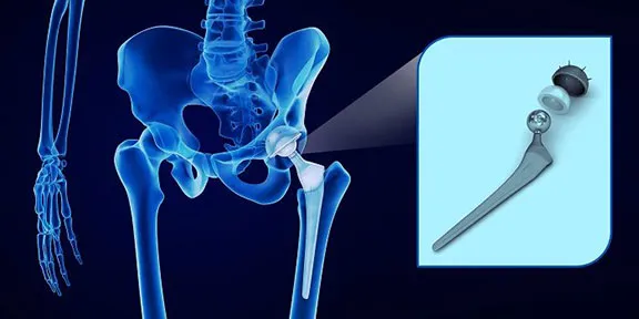 Zdjęcie Jak długo trwa rehabilitacja po endoprotezie stawu biodrowego? Oczekiwania i fakty