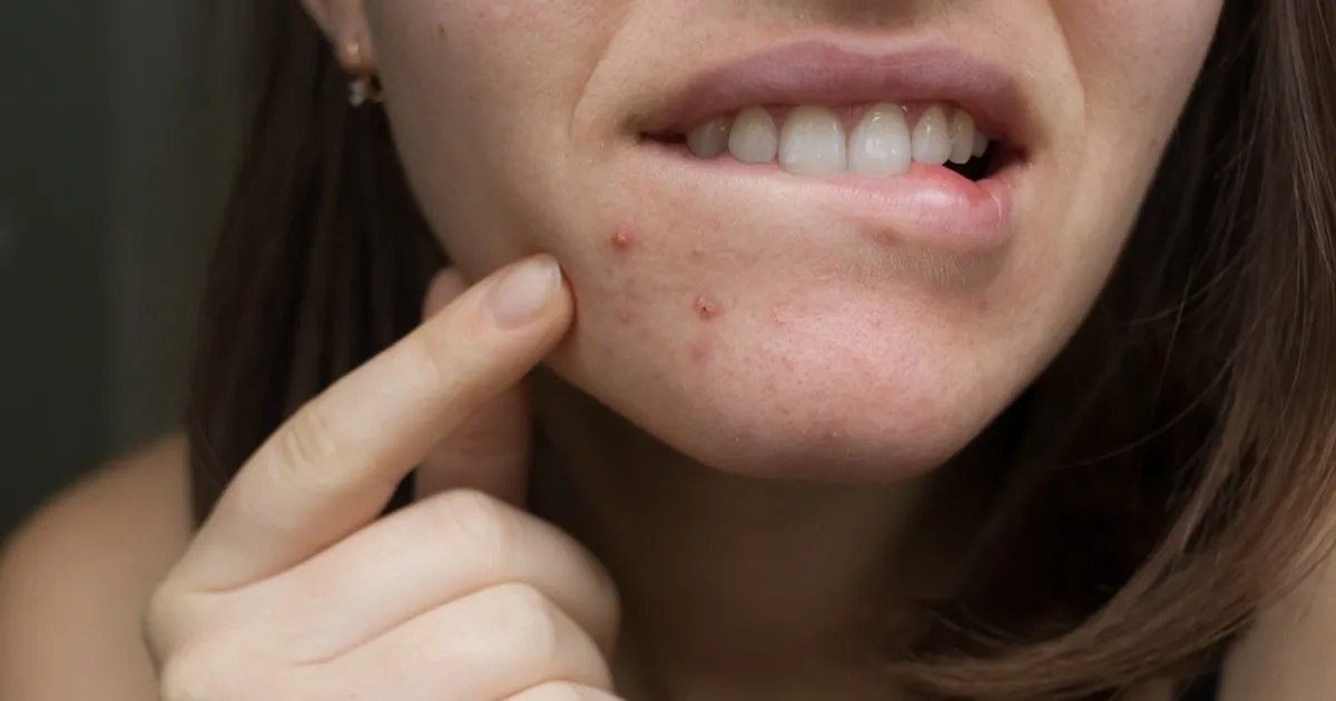 Zdjęcie Co jest w środku pryszcza i dlaczego to może być niebezpieczne