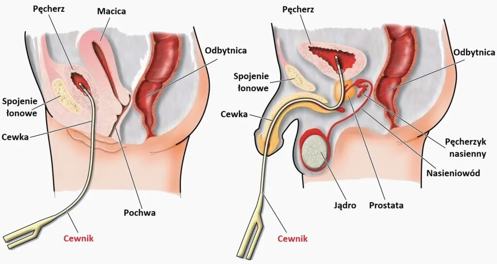 Zdjęcie Uszkodzenie cewki moczowej: objawy, przyczyny i powikłania