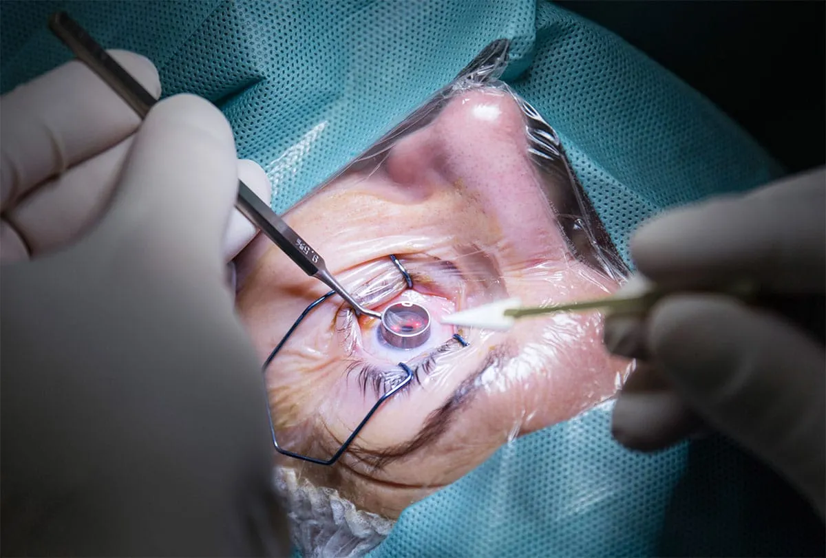 Zdjęcie Jak wyleczyć zaćmę - skuteczne metody i prawda o operacji