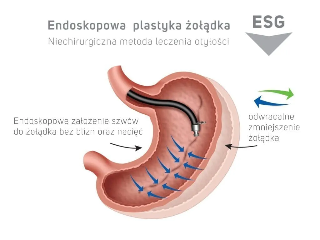 Zdjęcie Operacja zmniejszenia żołądka nfz gdzie - sprawdź najlepsze ośrodki w Polsce