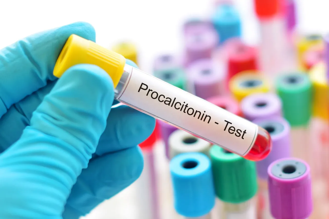 Zdjęcie Czym jest badanie PCT? Kluczowe informacje o prokalcytoninie