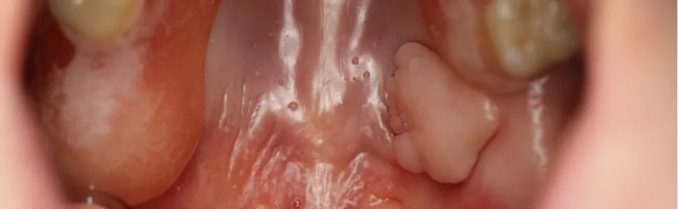 Zdjęcie Włókniak jamy ustnej objawy: co powinieneś wiedzieć o zmianach?