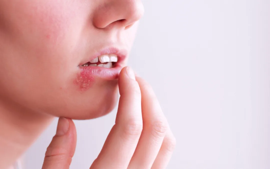 Zdjęcie Czy z opryszczką można iść do dentysty? Ryzyka i zalecenia przed wizytą