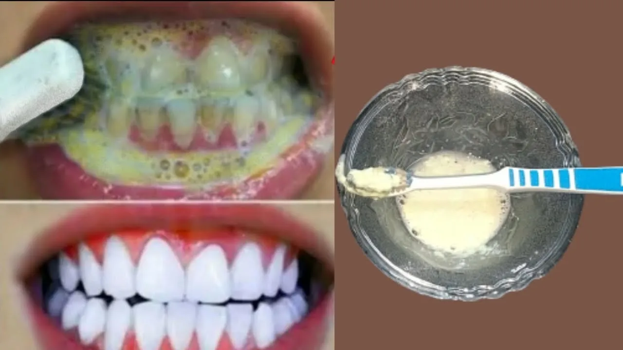 Zdjęcie Jak skutecznie usunąć kamień z zębów domowymi sposobami bez wizyty u dentysty